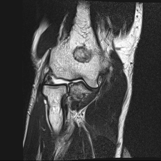 Hội chứng nếp hoạt dịch (Synovial fold syndrome - SFS)