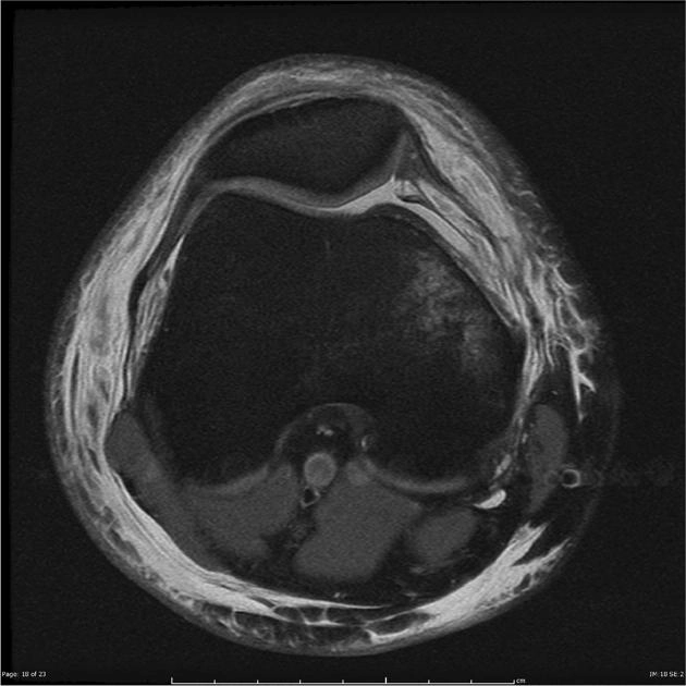Tổn thương dây chằng bánh chè-đùi trong (Medial patellofemoral ligament injury) 