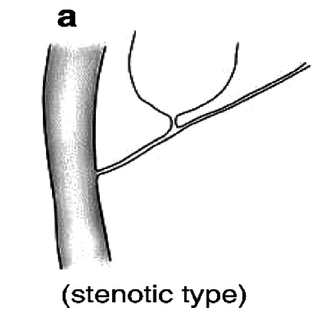Bất thường hợp lưu mật - tụy (Anomalous pancreaticobiliary junction - APBJ)
