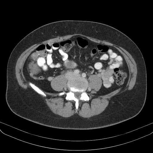 Thoái hóa nhầy của U xơ tử cung (Myxoid degeneration of a leiomyoma)
