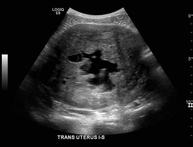 Thoái hóa Nang của u xơ tử cung (Cystic degeneration of a leiomyoma)