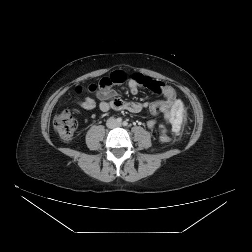 U cơ trơn phúc mạc lan tỏa (Diffuse peritoneal leiomyomatosis)