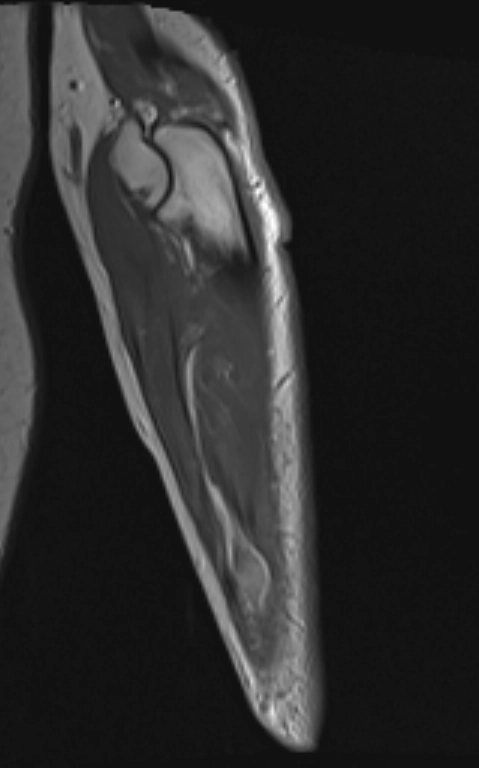 U thần kinh do chấn thương (Traumatic neuroma)