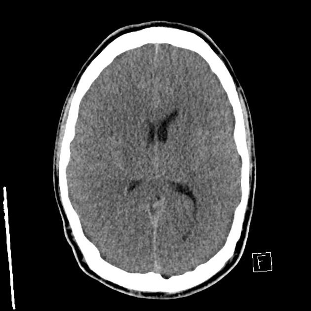 Tổn thương não do thiếu oxy-thiếu máu cục bộ ở người lớn (Adult Hypoxic-Ischemic Injury - HII)