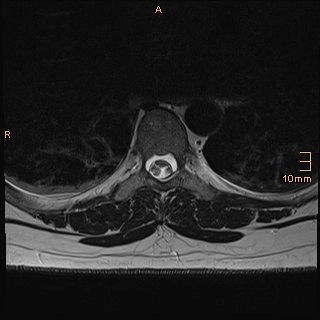 Thoát vị tủy sống ra trước (Ventral cord herniation)