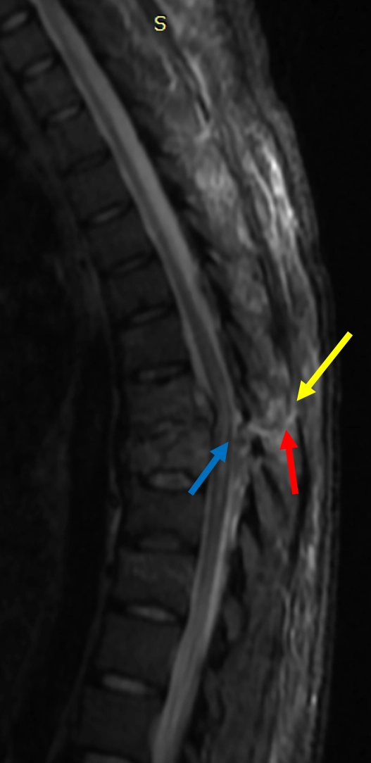 Tổn thương trượt xoay cột sống (Translation-rotation spine injuries)
