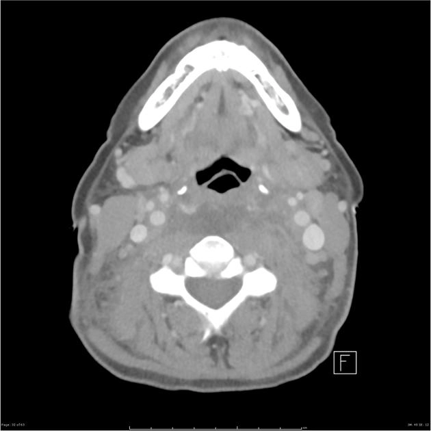 Tụ máu sau hầu tự phát (Spontaneous retropharyngeal hemorrhage)