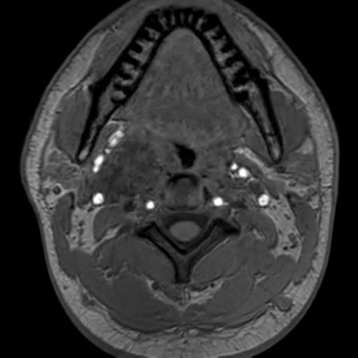 Schwannoma chuỗi giao cảm (Sympathetic Chain Schwannoma - SCSC)