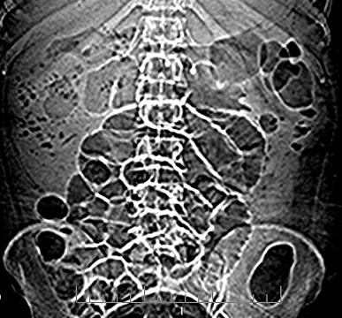 Viêm thận-bể thận sinh hơi (Emphysematous pyelonephritis)