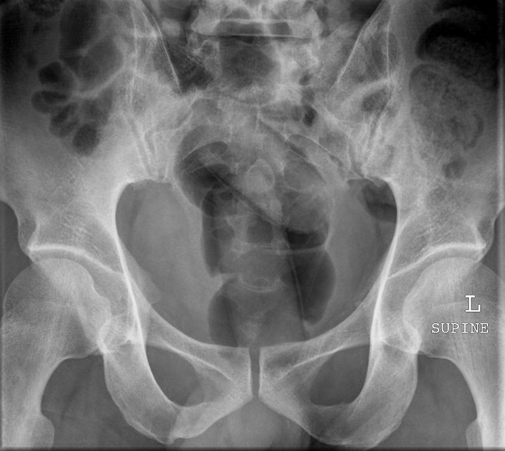 Dị vật trực tràng (Rectal foreign bodies)