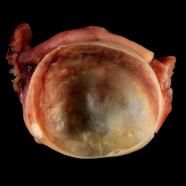 Nang buồng trứng (Ovarian cyst)