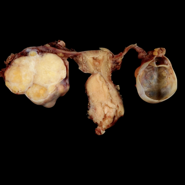 Phân loại giai đoạn ung thư cổ tử cung (Cervical cancer staging)