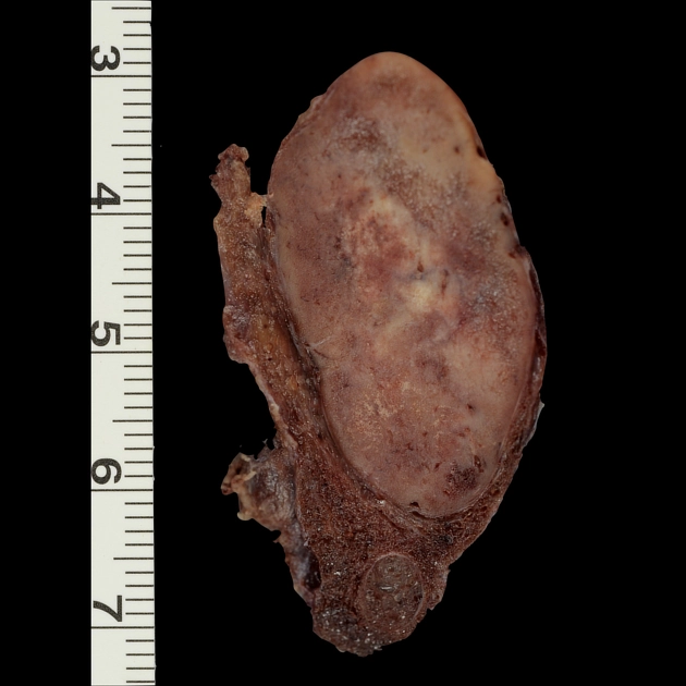 Adenoma tuyến giáp (Thyroid adenoma)