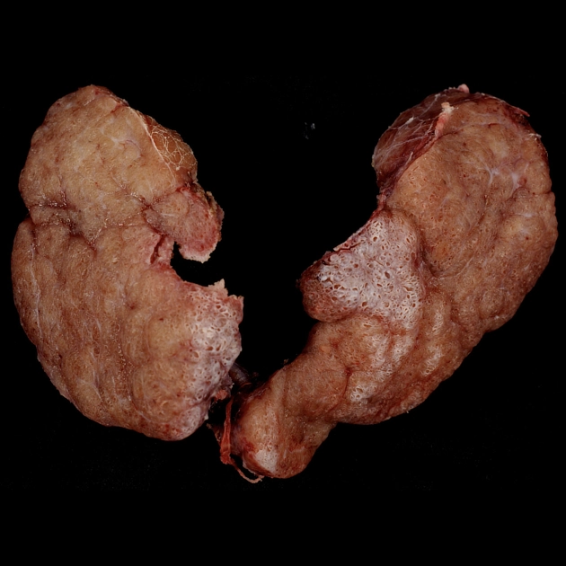 Bệnh Basedow (Graves disease)