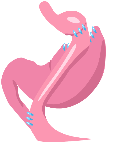 Phẫu thuật nối tắt dạ dày kiểu Roux-en-Y (Roux-en-Y gastric bypass surgery - RYGB)
