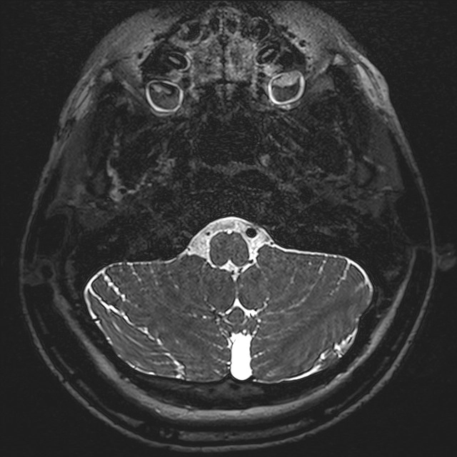 Thiểu sản ốc tai (Cochlear hypoplasia)