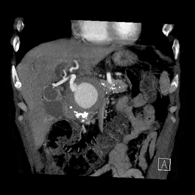 Giả phình mạch quanh tụy (Peripancreatic Pseudoaneurysm)