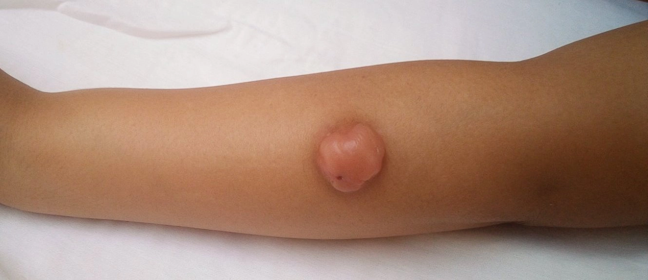 U nhầy (Myxoid soft tissue tumors)