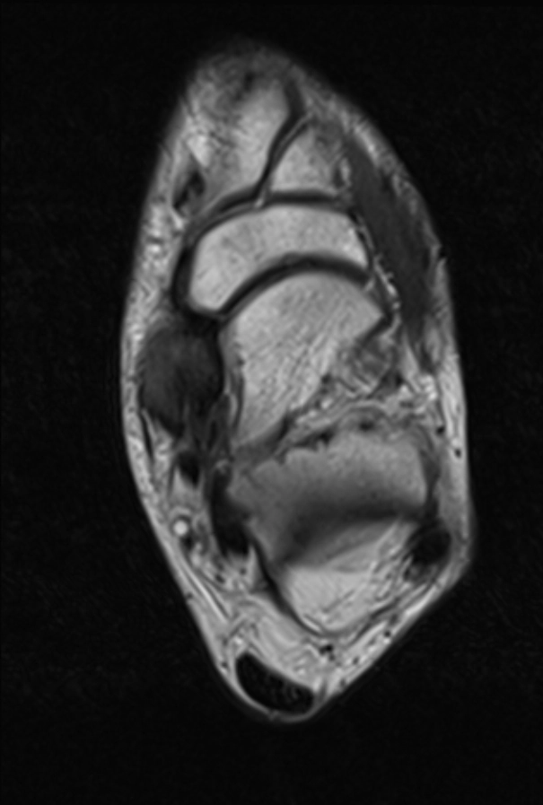 Tổn thương phức hợp dây chằng gót-ghe gan chân (Spring ligament complex injury)