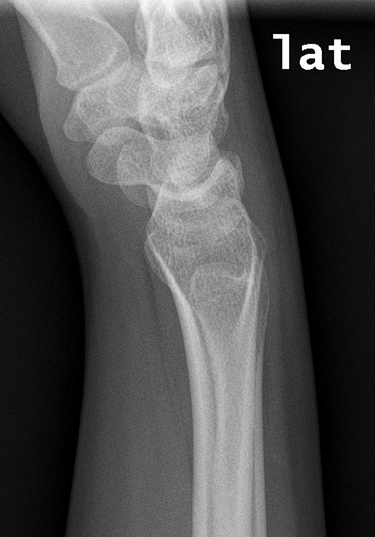 Dấu hiệu mỡ cơ sấp vuông (Pronator quadratus sign)
