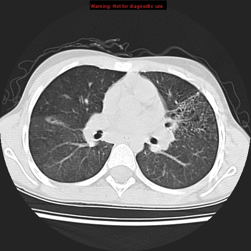 Rối loạn vận động nhung mao nguyên phát (Primary ciliary dyskinesia - PCD)