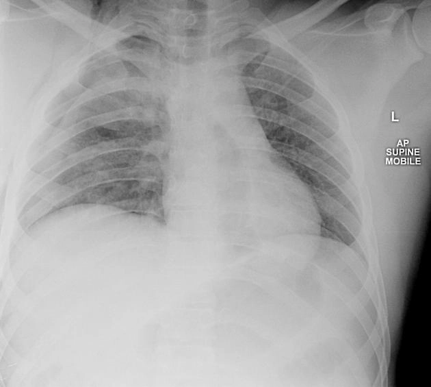 Chấn thương tuyến thượng thận (Adrenal gland trauma)
