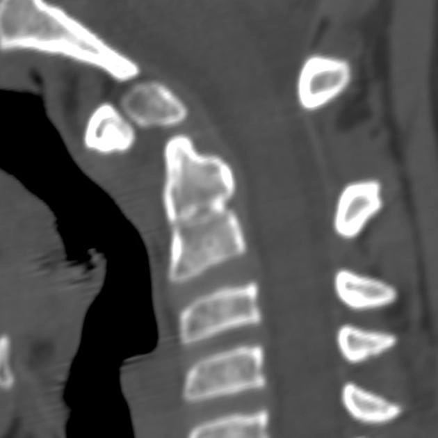 Mỏm răng tách rời (Os odontoideum)