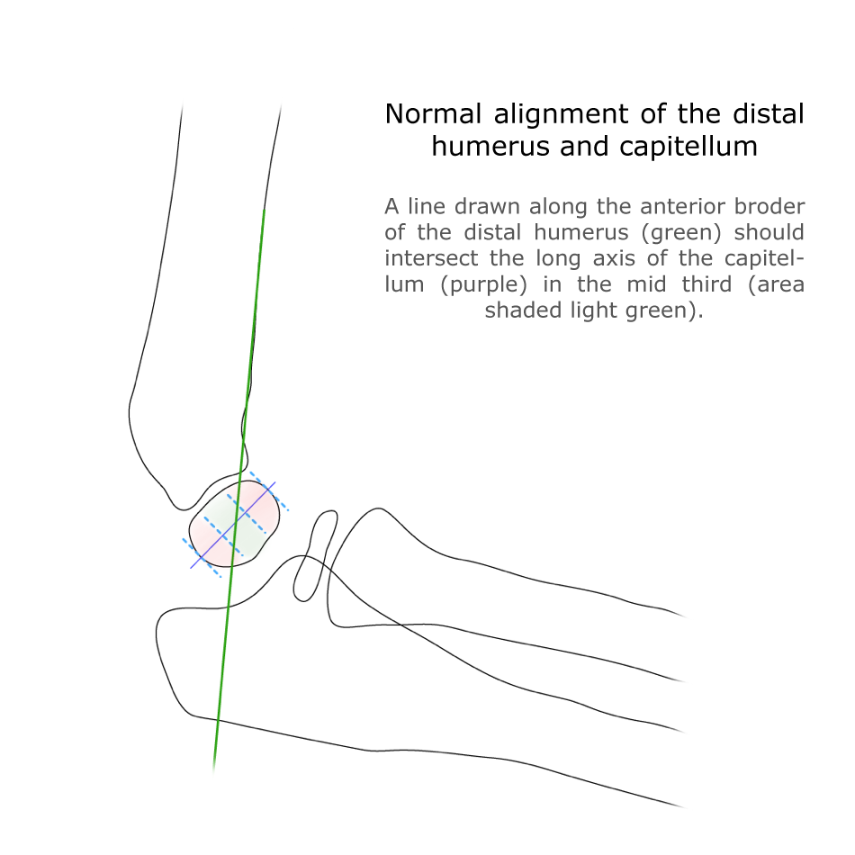 Đường cánh tay trước (Anterior Humeral Line - AHL)