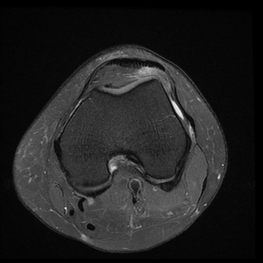 Hội chứng chèn ép túi mỡ Hoffa (Hoffa fat pad impingement syndrome)