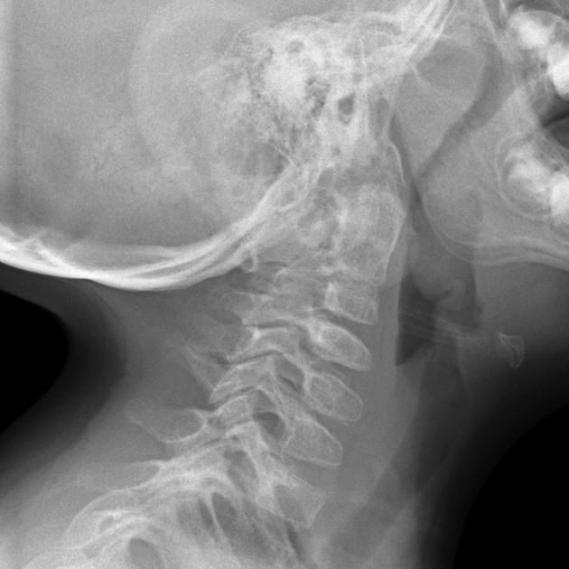 Dính chẩm-đội (Atlanto-occipital assimilation)