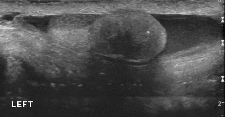 U giả dạng sợi của bìu (Fibrous pseudotumor of the scrotum)