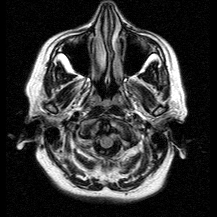 U màng não góc cầu tiểu não (CPA-IAC Meningioma)
