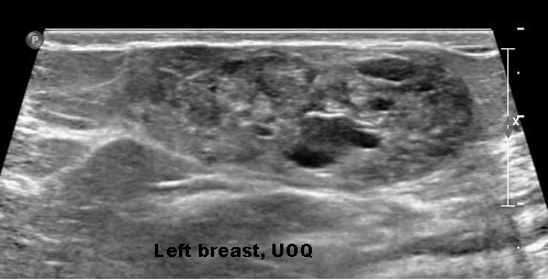 U tuyến của vú (Adenomatous breast lesions)