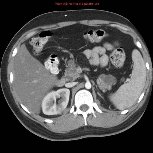Nang thận do Bệnh von Hippel-Lindau (Von Hippel-Lindau disease)