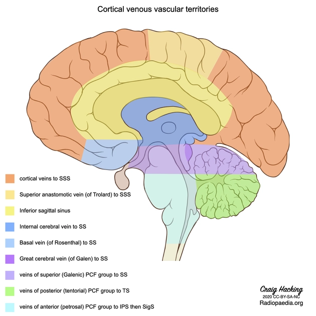 Huyết khối tĩnh mạch vỏ não (Cortical Vein Thrombosis - CVT)