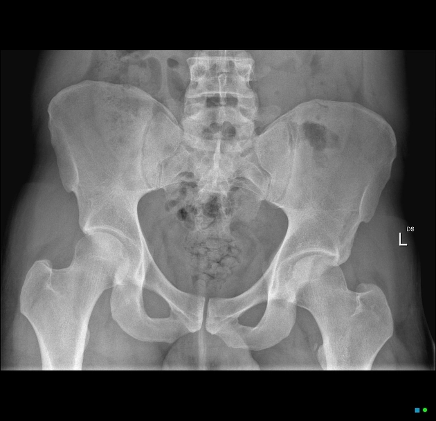 Tổn thương dây chằng tròn (Ligamentum teres injury)