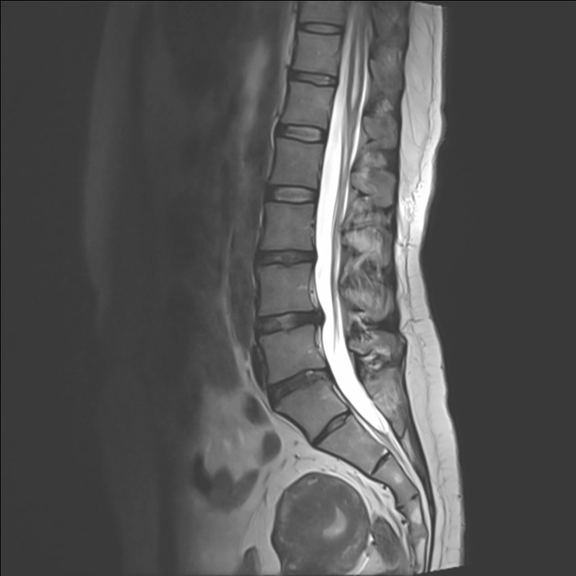 Tồn tại não thất ở ống tủy tận (Ventriculus terminalis)