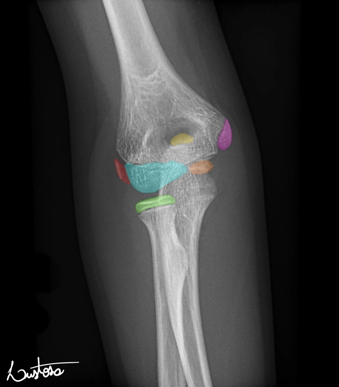 Cốt hóa khớp khuỷu (Elbow ossification (mnemonic))