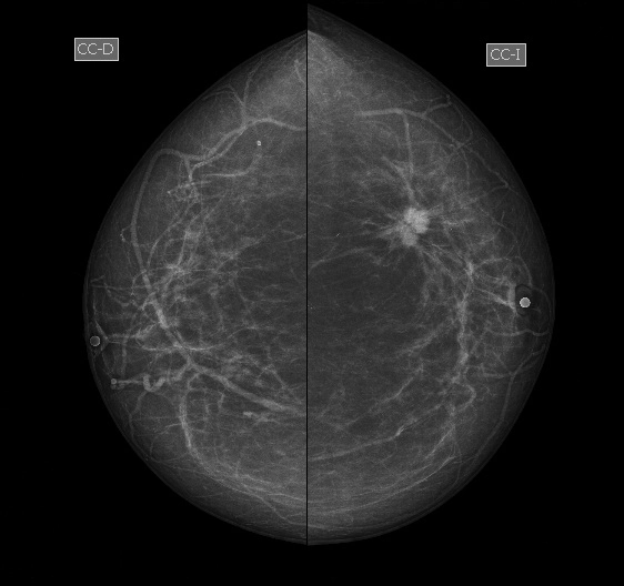 BI-RADS 5 (Breast imaging-reporting and data system (BI-RADS) assessment category 5)