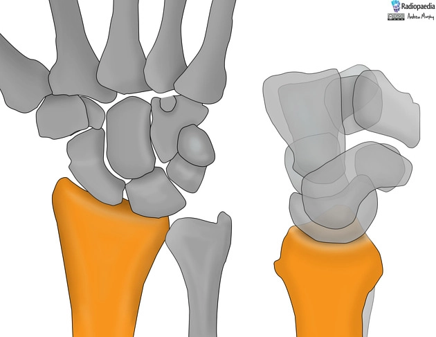 Giải phẫu xương cổ tay (Carpal bones)