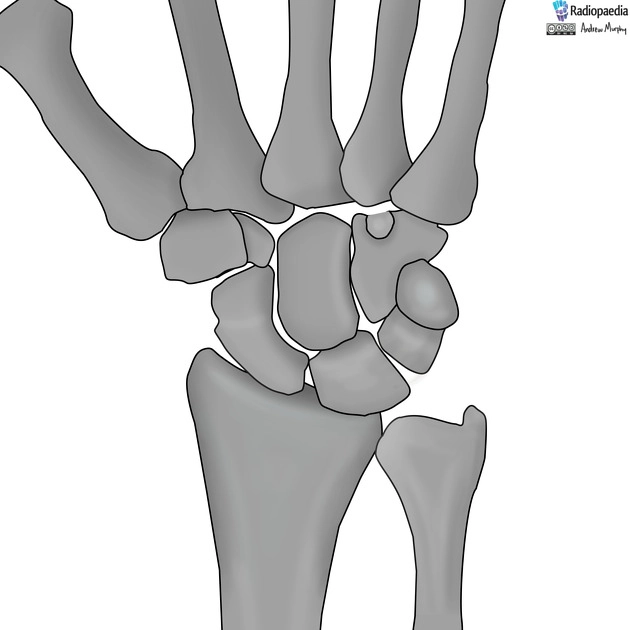 Hội chứng SNAC ở xương thuyền (Scaphoid Non-union Advanced Collapse)