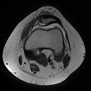 Gãy sụn khớp gối (Chondral Fracture)