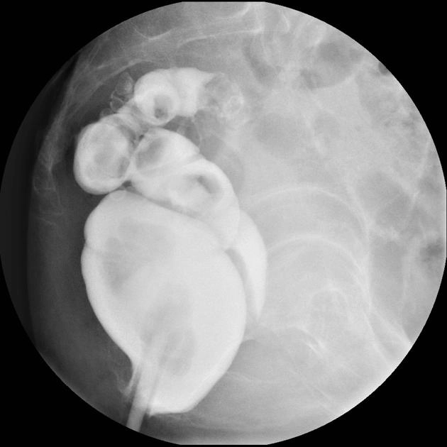 Rò đại tràng - âm đạo (Colovaginal fistula)