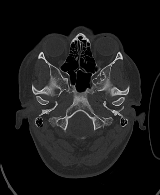 Hạt màng nhện lạc chỗ (Aberrant arachnoid granulations)