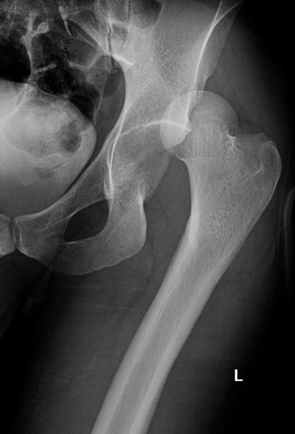 Trật khớp háng ra sau (Posterior hip dislocation - PHD)