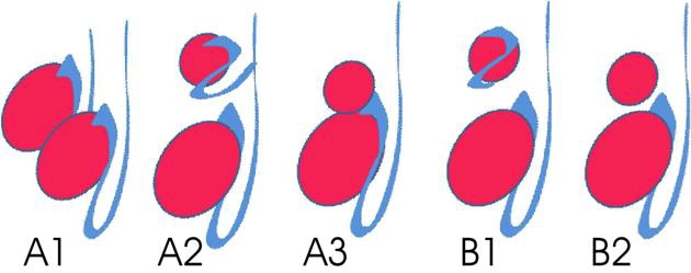 Đa tinh hoàn (Polyorchidism)