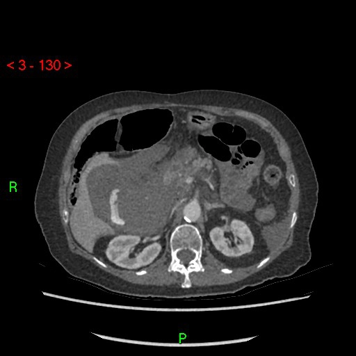 Viêm túi mật xuất huyết (Hemorrhagic cholecystitis)