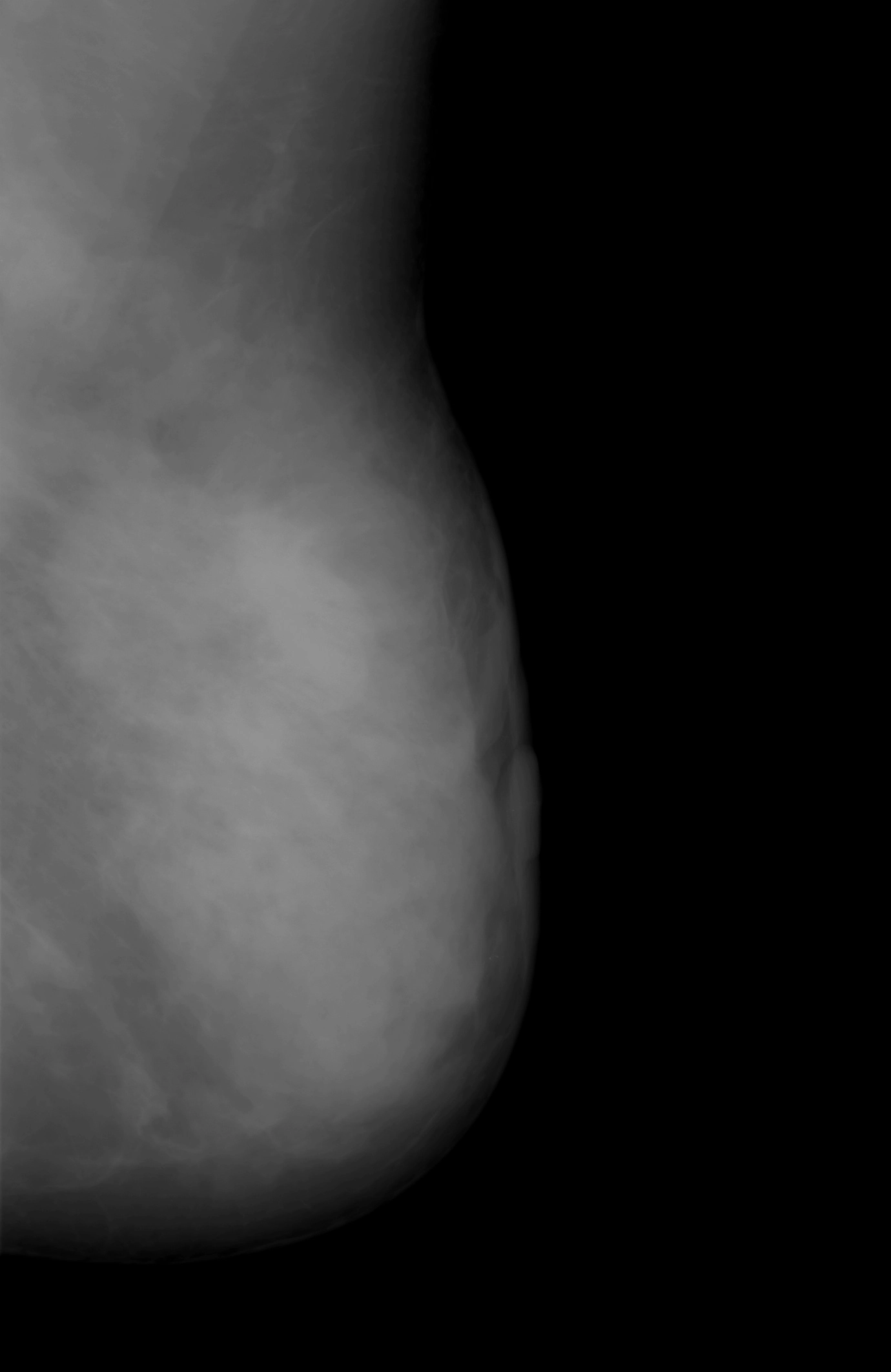 Ung thư biểu mô tuyến vú xâm nhập loại không đặc biệt (Invasive breast carcinoma of no special type)