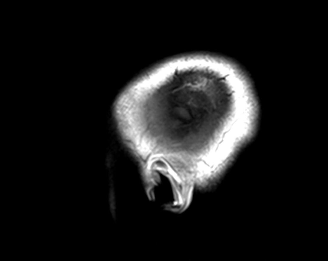 U màng não lỗ tĩnh mạch cảnh (Jugular Foramen Meningioma)