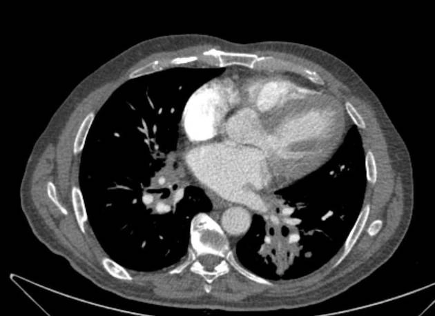 Dày thành quanh mạch máu phế quản (Peribronchovascular Thickening) 